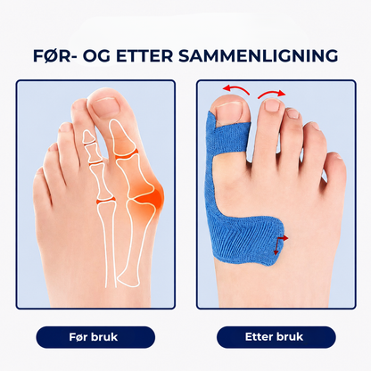 AlignTape™ | Ferdigklippet elastisk kinesiologitape for støtte ved hallux valgus