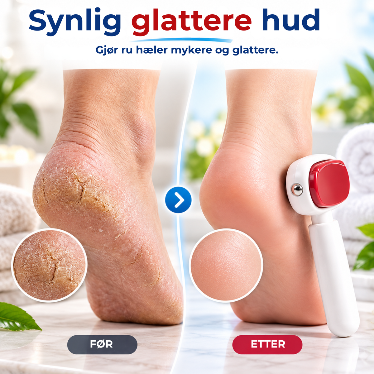 FootRefiner™ | Fjern hard hud og få mykere hæler