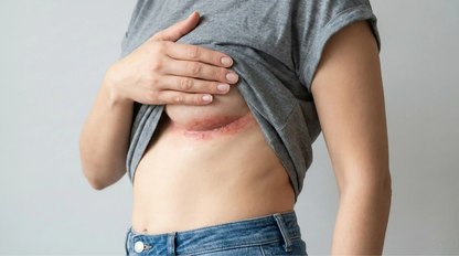 SkinRestore™ | Behandler 94% av hudirritasjon i hudfolder fra første bruk