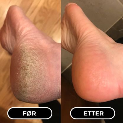 MykHæl™ | Når vanlig fotkrem ikke lenger fungerer