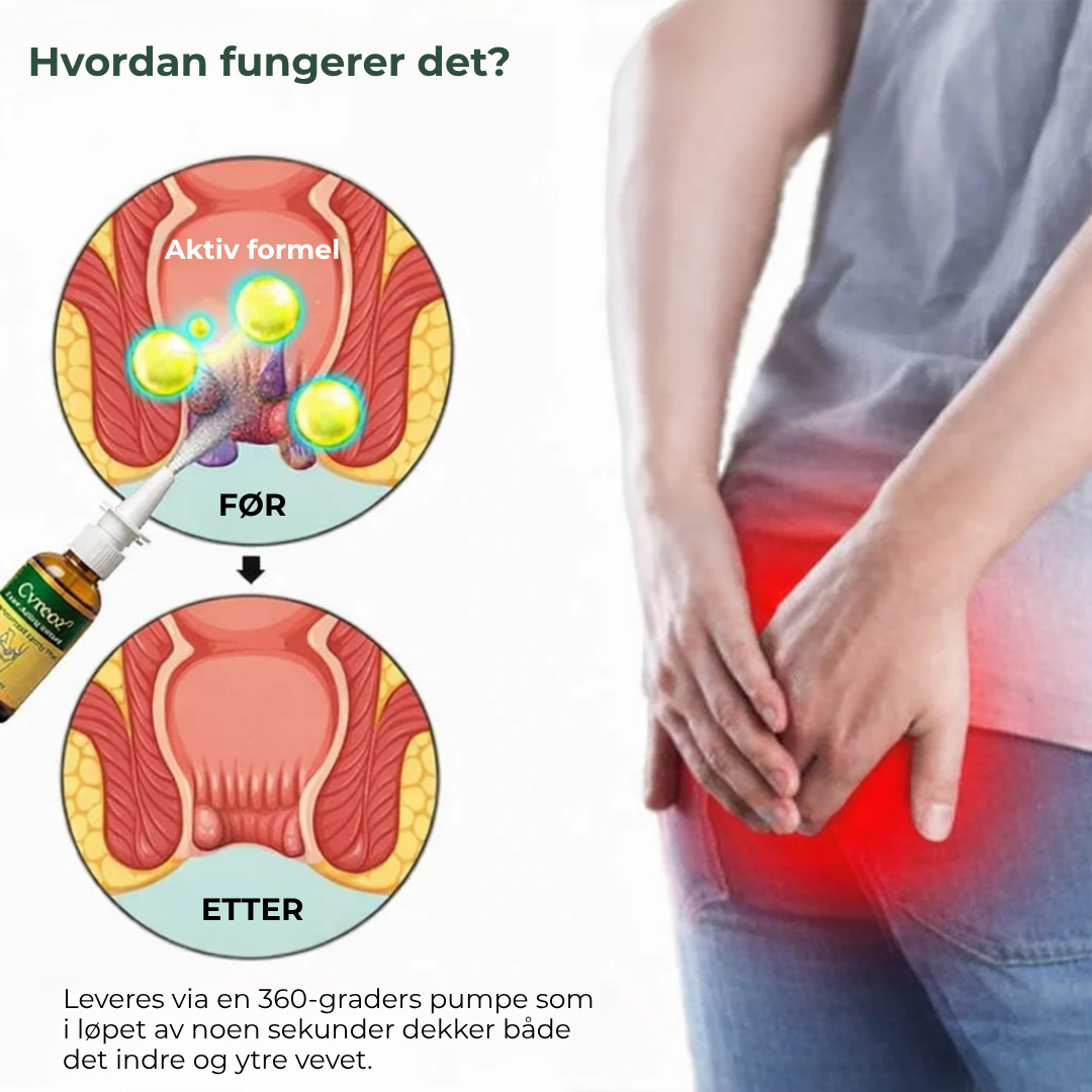 CalmEase™ | Hurtigvirkende, urtebasert spray mot hemoroider