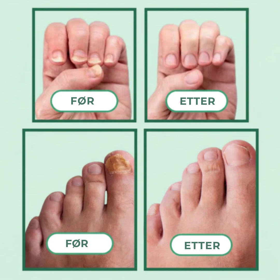 PureNail™ | Blått lys neglebehandlingsenhet