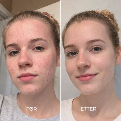 DermaClear™ | Rens huden på få minutter